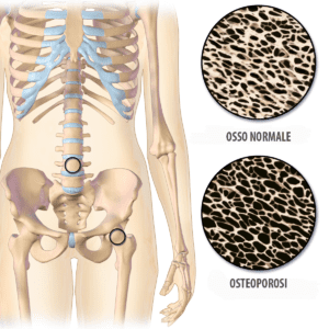 osteoporosi rimedi